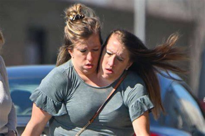 Are there any conjoined twins in the United States?