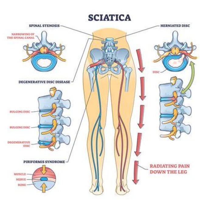 Can hardly walk with sciatica?