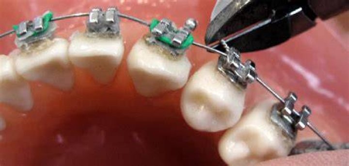 Can I cut my braces wire with scissors?