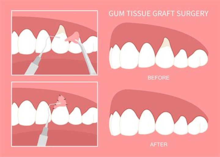 Can I drink tea after gum grafting?