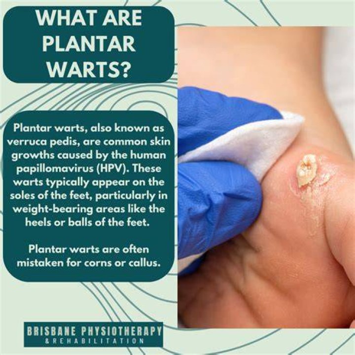 Can I pick my wart?