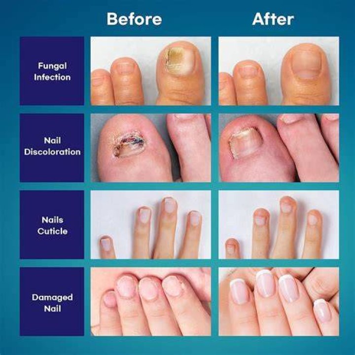 Can toe fungus live in nail polish?