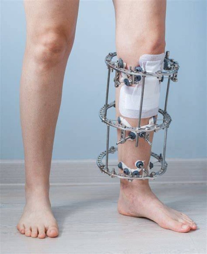 Can you walk with an Ilizarov frame?