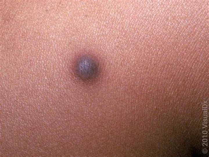 Do dermatofibromas appear suddenly?