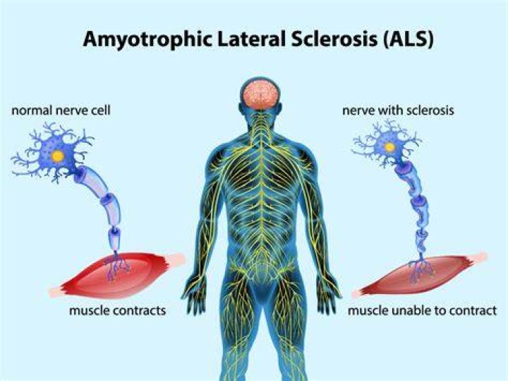 Does ALS cause hair loss?