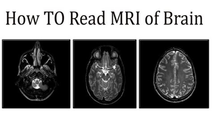 Does brain MRI show eye problems?