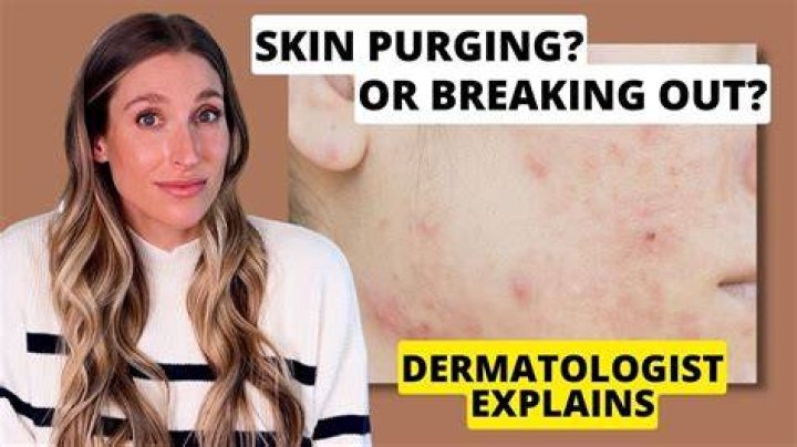 How do you deal with skin purging?