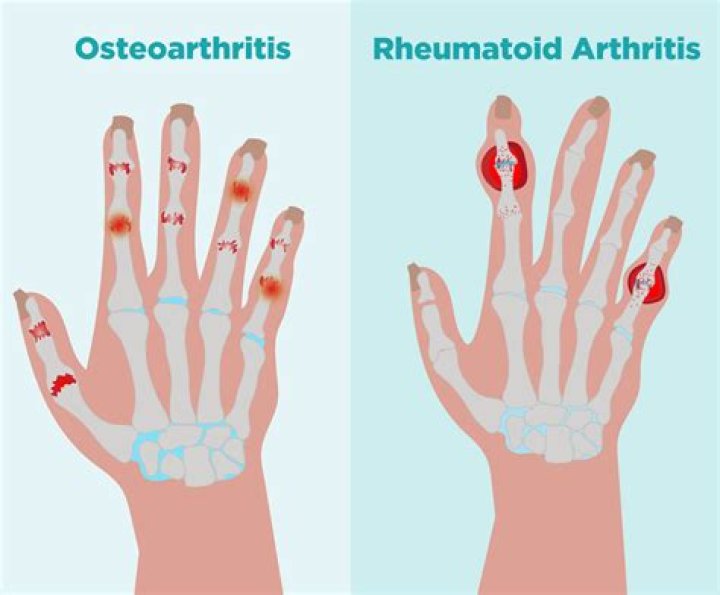 How do you know if you've got rheumatoid arthritis?