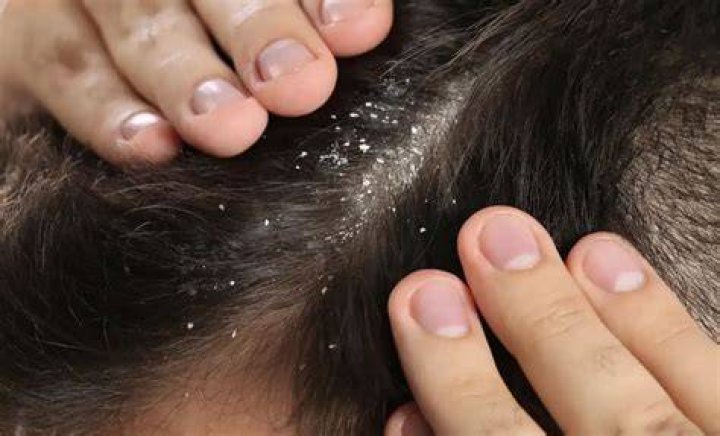 【How-to】Can lice cause dandruff - Howto.org