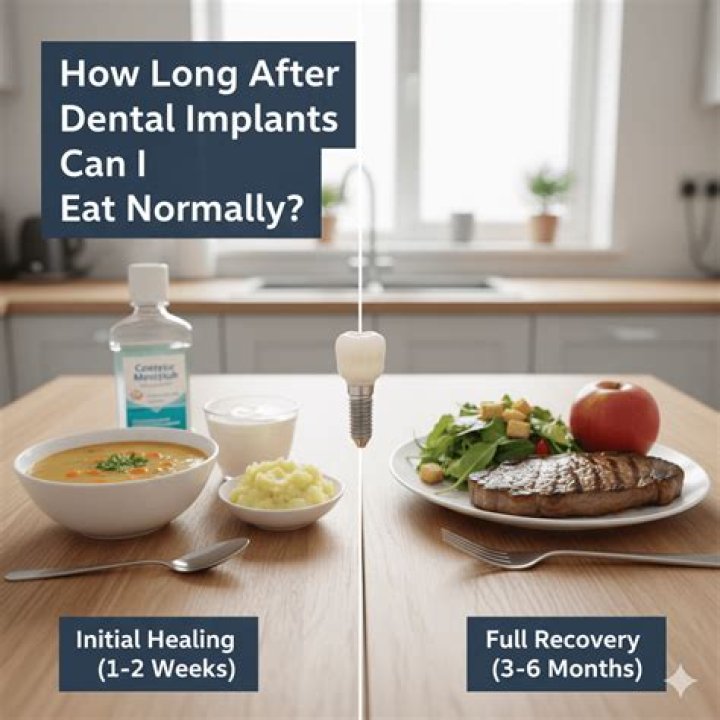 【How-to】How long after dental implants can i eat normally