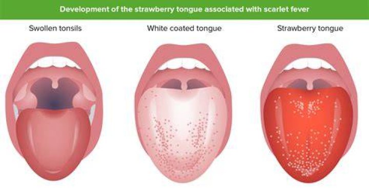 【How-to】How long does scarlet fever last
