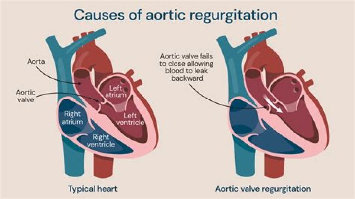 【How-to】How to Diagnose Aortic Regurgitation