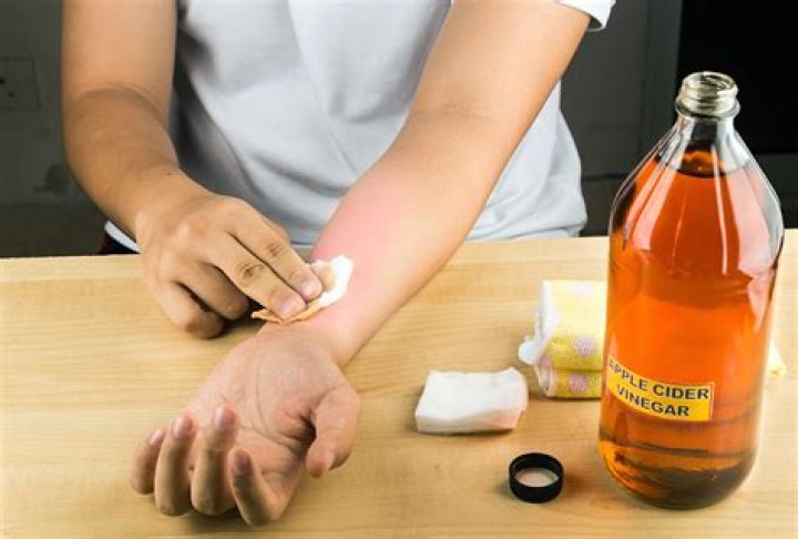 【How-to】How to Treat Apple Cider Vinegar Burns
