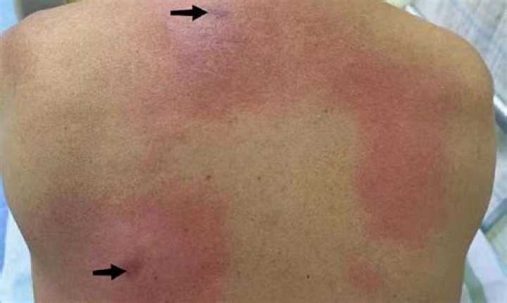 【How-to】What does an allergic reaction to chapstick look like