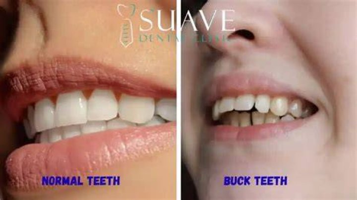 【How-to】What is bucktooth butternut - Howto.org