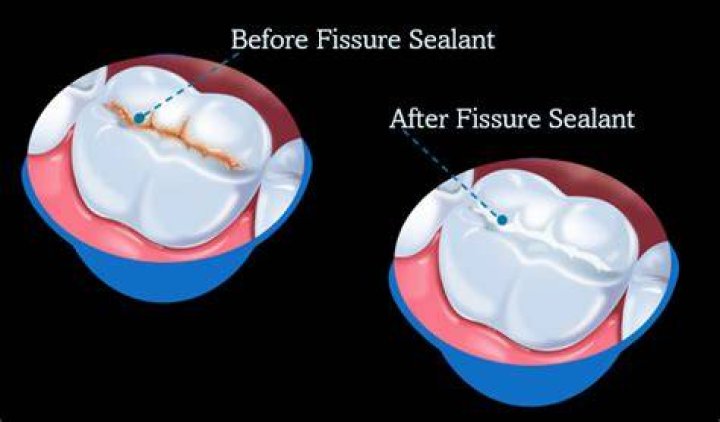 Is a fissure seal a filling?