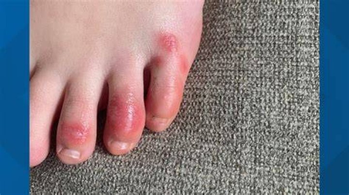 What are Covid toes?