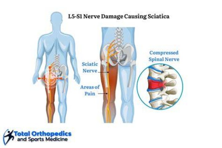 What are the symptoms of nerve damage in the lower back?