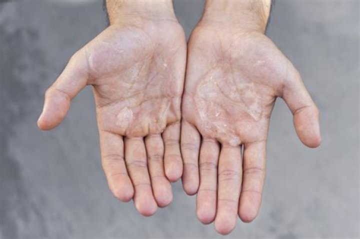 What causes static in hands?
