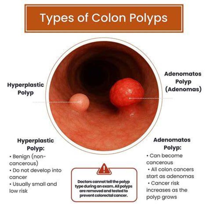 What happens when they find polyps during colonoscopy?