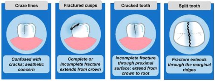 What is a crack line?