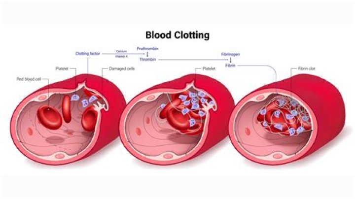 What will happen if you have a blood clot?
