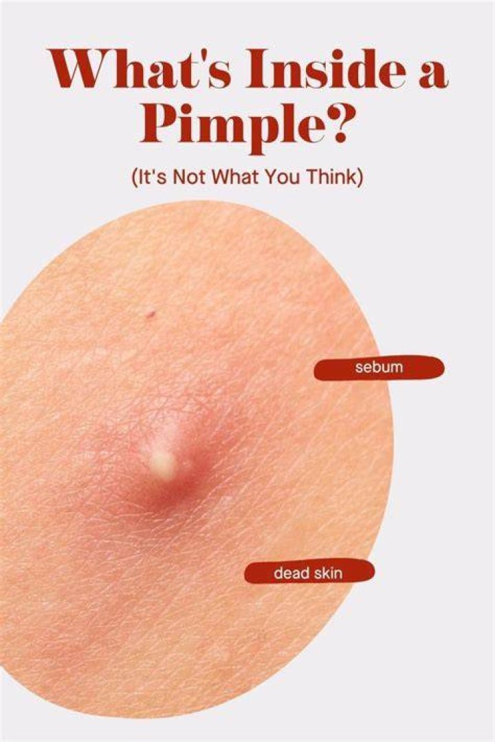 Why is this pimple so hard?