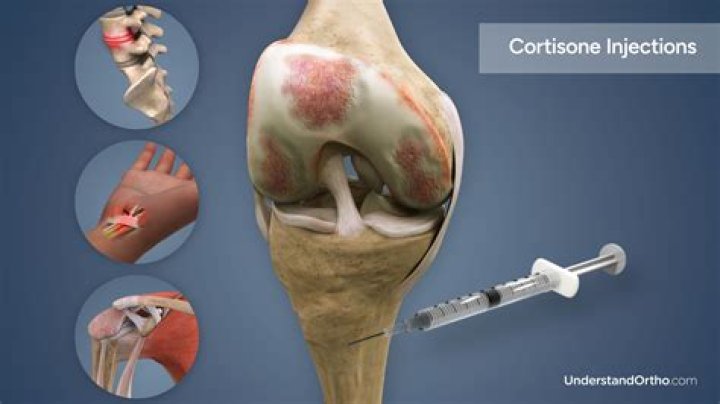 Will a cortisone shot help fibromyalgia?